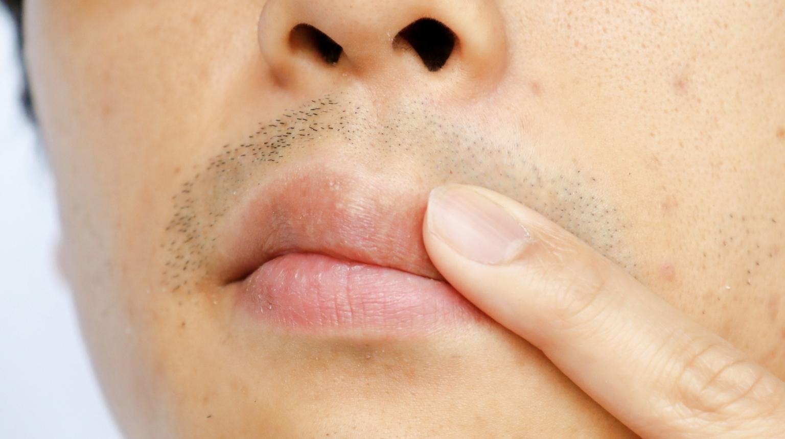 Causes of Dry Mouth