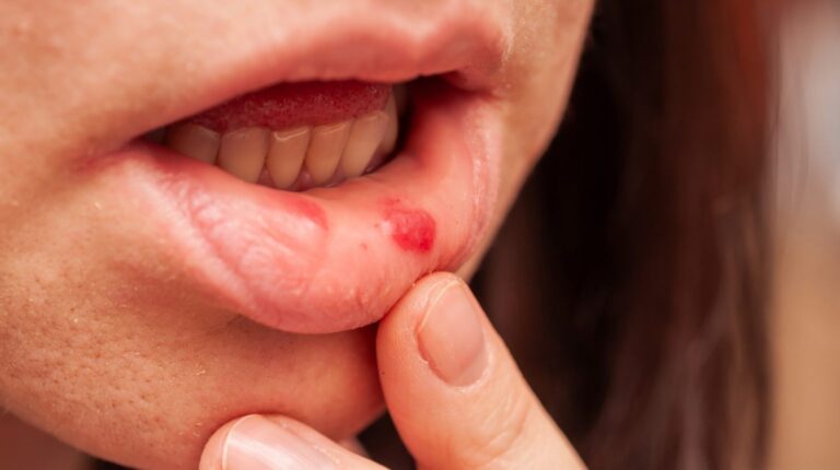 Home Remedies for Mouth Ulcers: Natural Relief for Painful Sores
